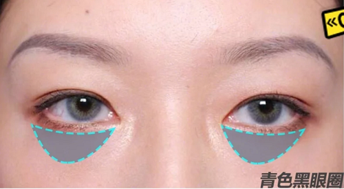 黑眼圈形成的三种原因 如何快速有效消除黑眼圈的三种方法