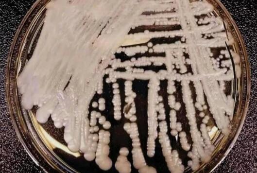 超级真菌在美爆发中国确诊18例