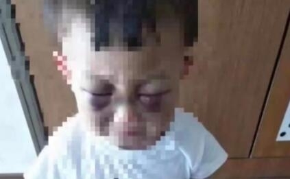幼童遭继母虐待满身淤青令人气愤 对3岁男童下毒手遭刑拘