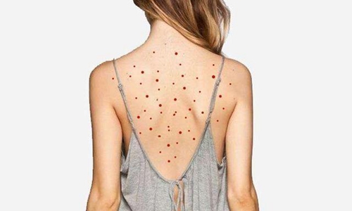 背部长痘是什么原因导致的 背部痘痘的治疗方法